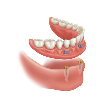 Implant Overdenture