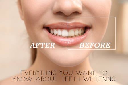 Everything You Want to Know About Teeth Whitening (featured image)