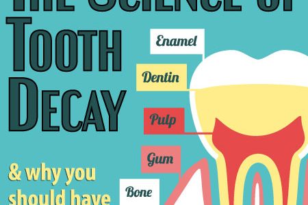 The Science of Tooth Decay (featured image)