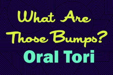 What Are Those Bumps? Oral Tori (featured image)