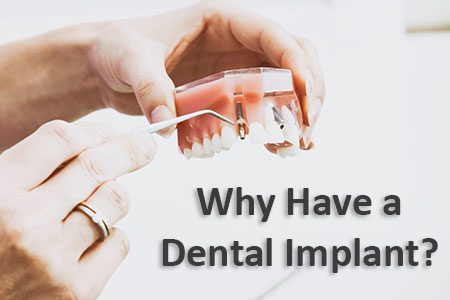 Why Have a Dental Implant? (featured image)